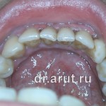 Лечение пародонтита - исходная ситуация