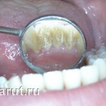Лечение пародонтита - исходная ситуация