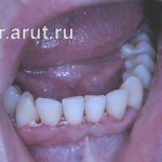 После удаления зубных отложений и медикаментозной обработки