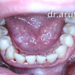 После удаления зубных отложений и медикаментозной обработки