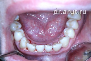 После удаления зубных отложений и медикаментозной обработки