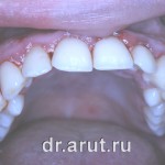 После удаления зубных отложений и медикаментозной обработки