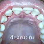 После удаления зубных отложений и медикаментозной обработки