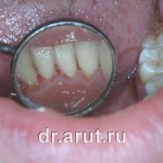 После удаления зубных отложений и медикаментозной обработки