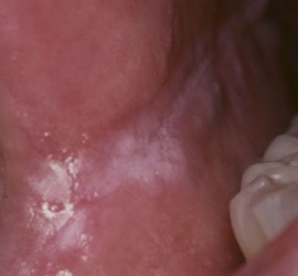 Лейкоплакия