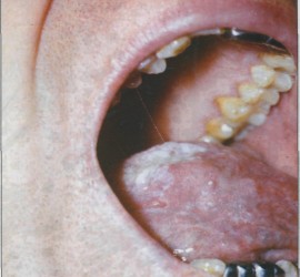 Лимфангиома