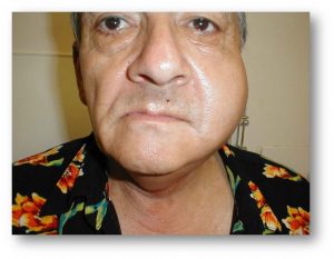 Острый лимфогенный паротит