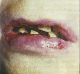 Лучевые поражения полости рта
