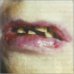 Лучевые поражения полости рта