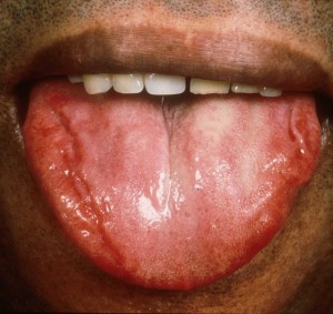 Макроглоссия