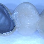 Металлокерамический мостовидный протез после нанесения эмалевого слоя