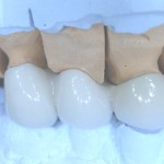 Металлокерамический мостовидный протез после нанесения глазури