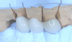 Металлокерамический мостовидный протез после нанесения глазури