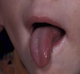 Микроглоссия