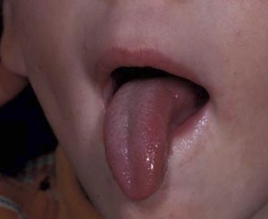 Микроглоссия