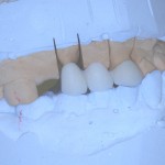 Металлокерамический мостовидный протез после нанесения эмалевого слоя