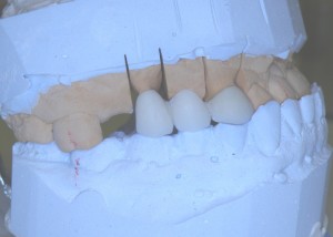 Металлокерамический мостовидный протез после нанесения эмалевого слоя