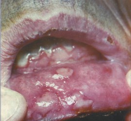 Экссудативная многоформная эритема