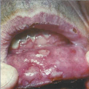 Экссудативная многоформная эритема