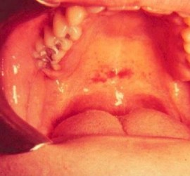 Мононуклеоз инфекционный