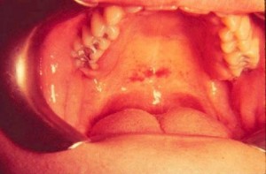 Мононуклеоз инфекционный (моноцитарная ангина)