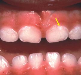 Очаговая деминерализация эмали