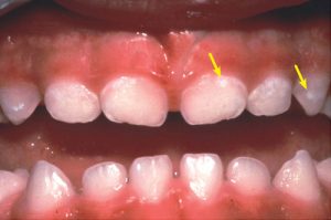 Очаговая деминерализация эмали