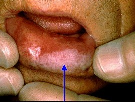 Ограниченный предраковый гиперкератоз красной каймы губ
