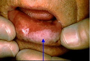 Ограниченный предраковый гиперкератоз красной каймы губ