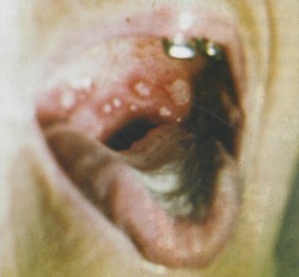 Острый герпетический стоматит