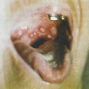 Острый герпетический стоматит