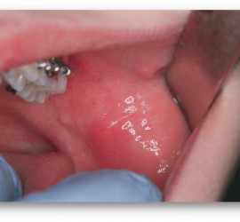 Острый сиаладенит при эпидемическом паротите