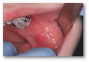 Острый сиаладенит при эпидемическом паротите