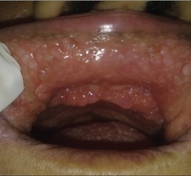 Папилломатоз