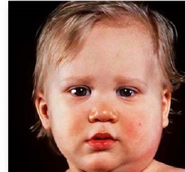 Заболевание встречается редко, обычно у больных и ослабленных детей. Иногда паротит развивается у новорожденных непосредственно в родильном доме.