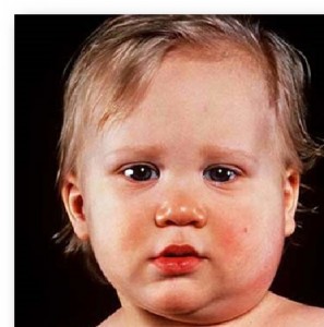 Паротит новорожденного Паротит новорожденного