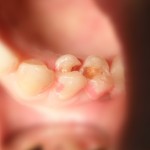 Пломба - До лечения