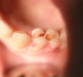 Пломба - До лечения