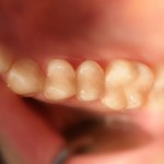 Пломба - после лечения