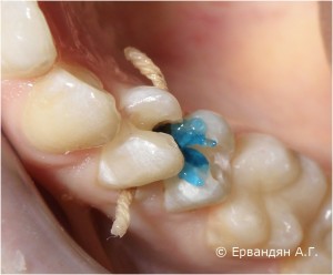Протравливание зубов