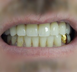 Полная потеря зубов - После