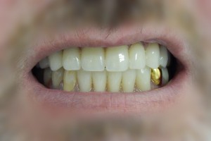 Полная потеря зубов - После