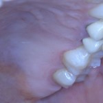 Зуб после фиксации керамической вкладки