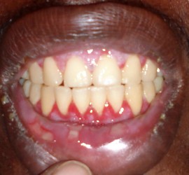 Пузырчатка