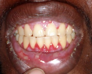 Пузырчатка