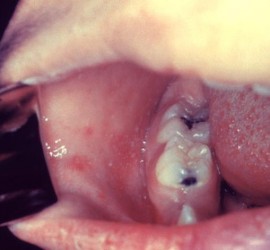 Коплика-Филатова пятна