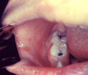 Коплика-Филатова пятна