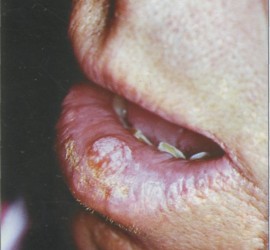 Рак нижней губы