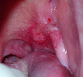 Рак слизистой оболочки ротоглотки