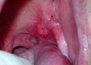 Рак слизистой оболочки ротоглотки